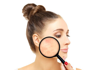 Top 5 kosmetyków do pielęgnacji skóry trądzikowej u dorosłych